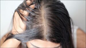 Cách chăm sóc da đầu tóc bị gàu