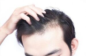Hói đầu nam và cách chữa trị