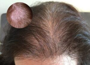 Vảy nến da đầu là gì?