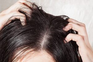 Dầu gội trị gàu an toàn và hiệu quả