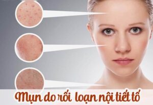 Cách trị mụn nội tiết tố