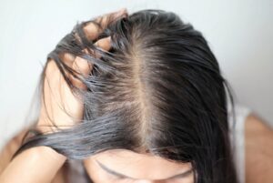 Da đầu nhiều dầu