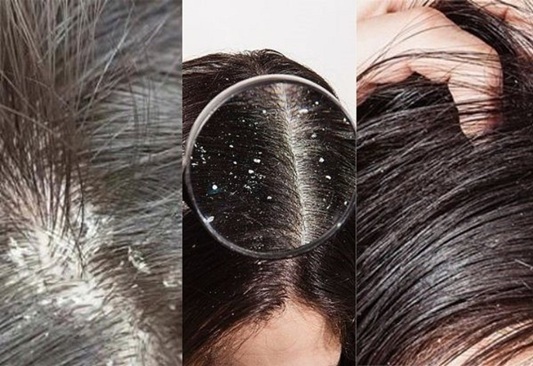 OoaBeauty trị gàu và ngứa da đầu