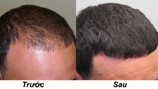 Cách trị rụng tóc hói đầu