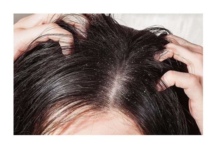 OoaBeauty trị gàu 1 OoaBeauty trị gàu phù hợp với tóc